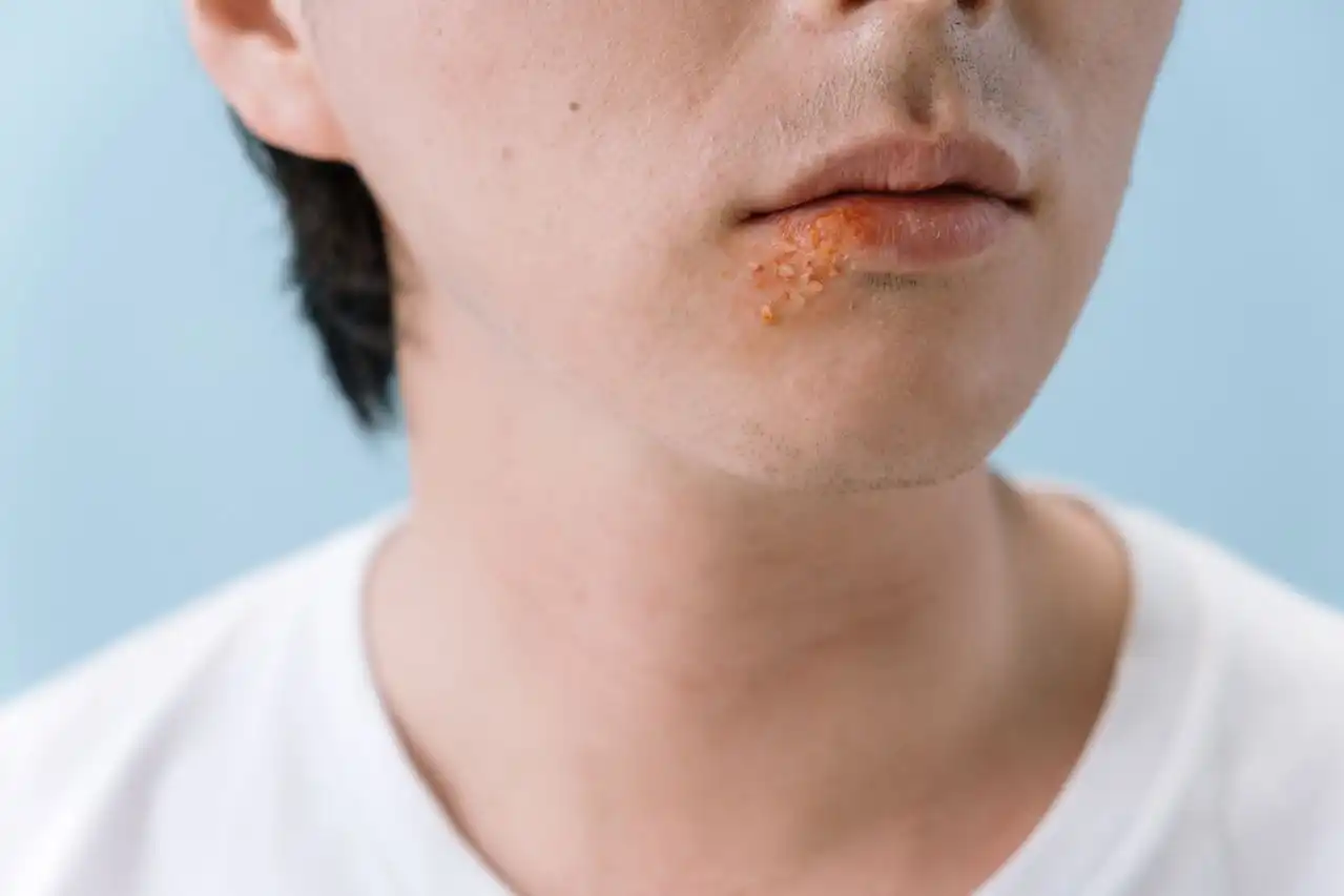 Close-up of the lower face with golden, crusted impetigo sores at the corner of the mouth